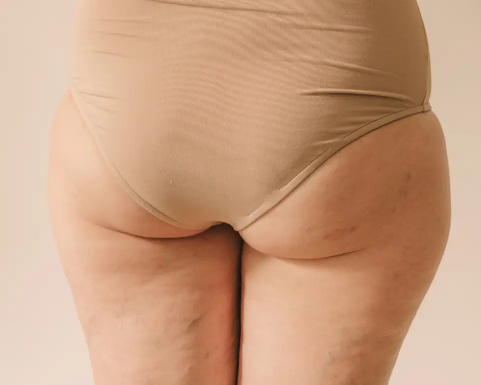 tumescente liposuctie