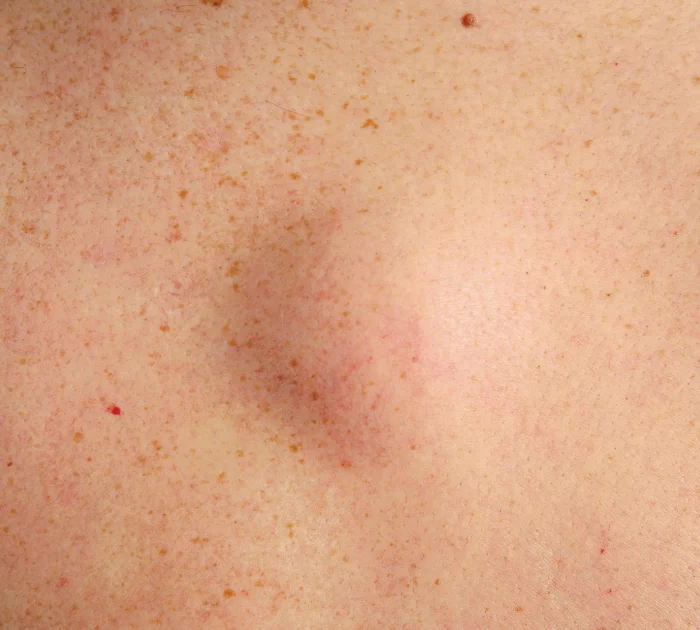 Lipoom verwijderen - ervaringen Lipoom laten behandelen