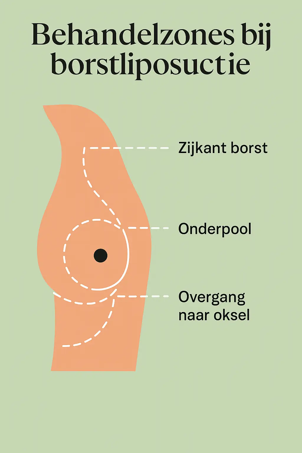 Behandelzones bij borstliposuctie infographic