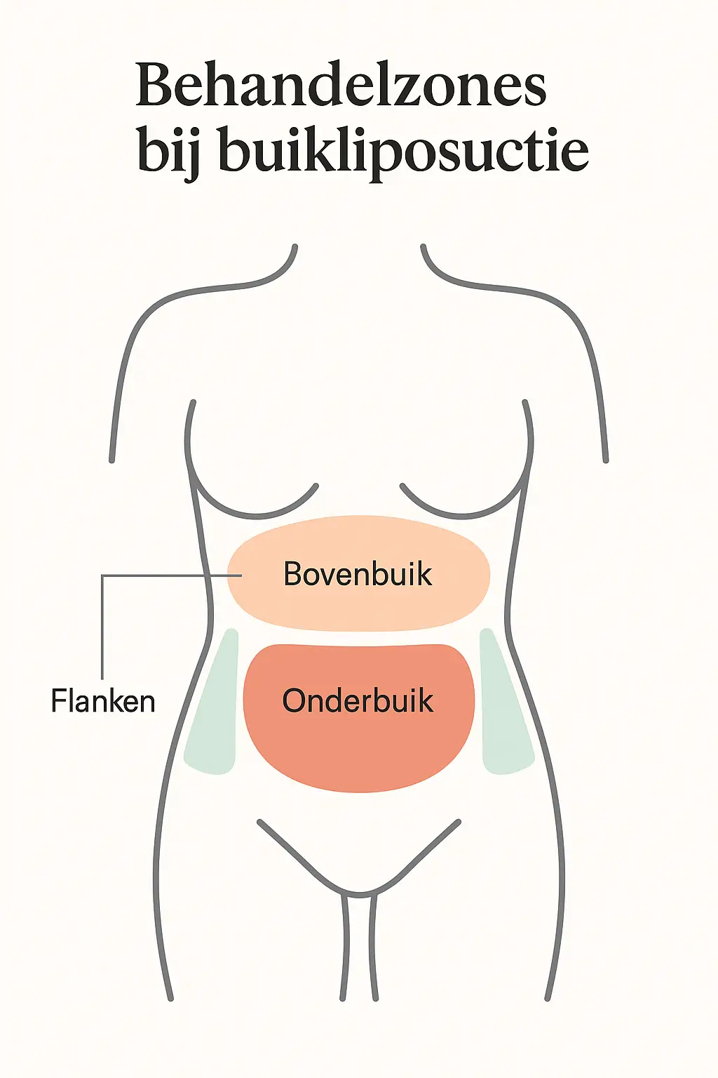 Zones buikliposuctie infographic