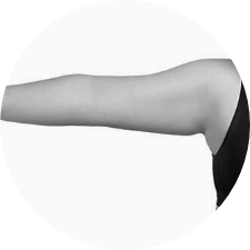 Liposuctie armen