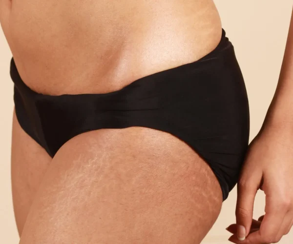 Liposuctie benen kosten