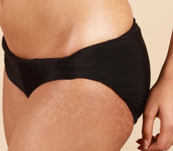 Liposuctie benen kosten