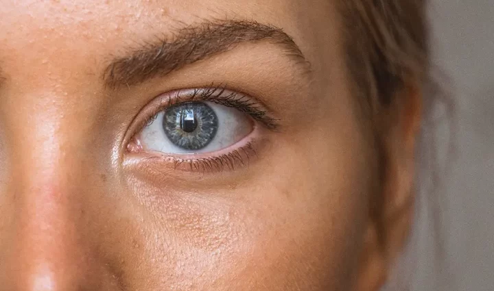 Allergie of irritatie