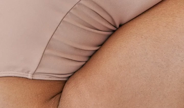 Lipoedeem types: waar zit lipoedeem?