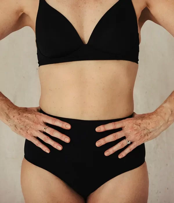 Lipofilling