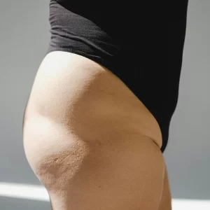 Liposuctie venusheuvel met Tumescent Techniek