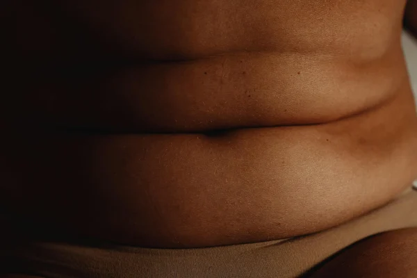 Liposuctie flanken met Tumescent Techniek
