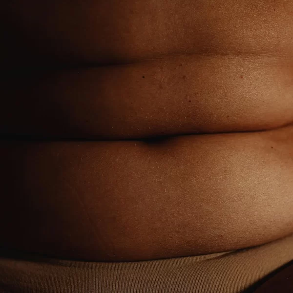 Liposuctie flanken met Tumescent Techniek