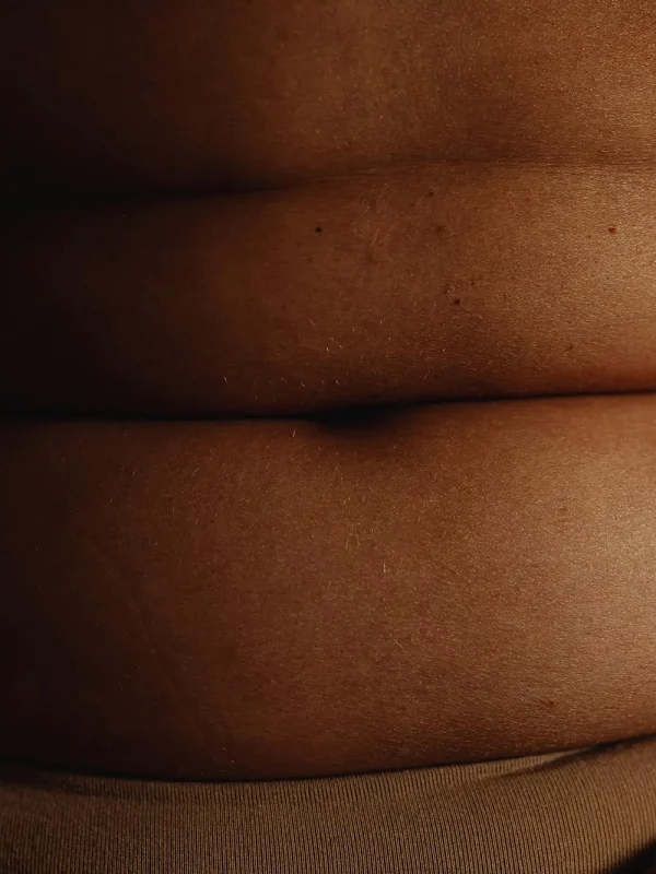 Liposuctie flanken met Tumescent Techniek