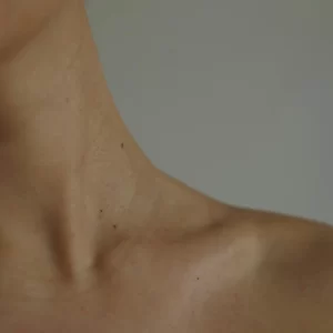 Liposuctie hals met Tumescent Techniek