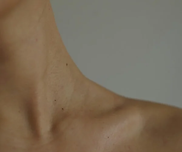 Liposuctie hals met Tumescent Techniek