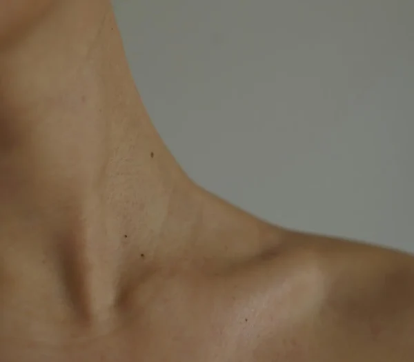 Liposuctie hals met Tumescent Techniek
