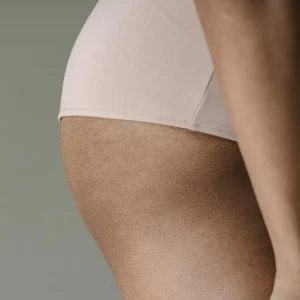 Liposuctie zadeltassen met Tumescent Techniek