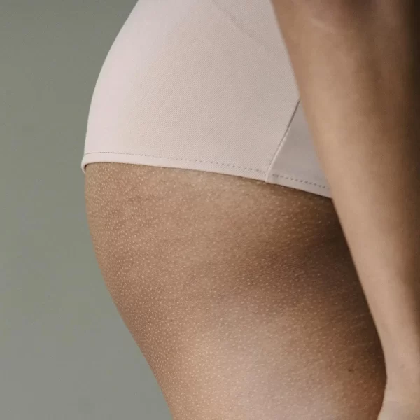 Liposuctie zadeltassen met Tumescent Techniek