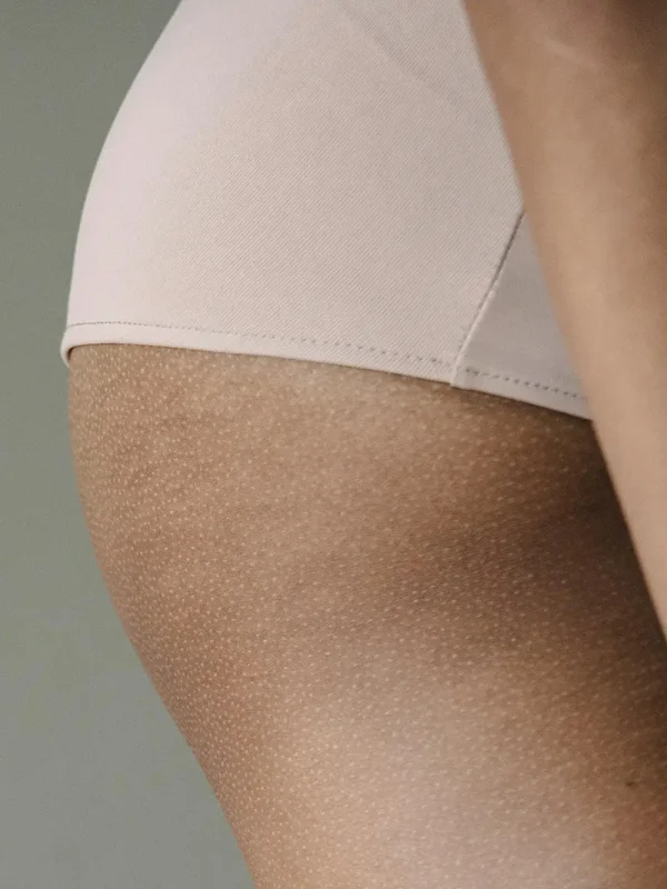 Liposuctie zadeltassen met Tumescent Techniek
