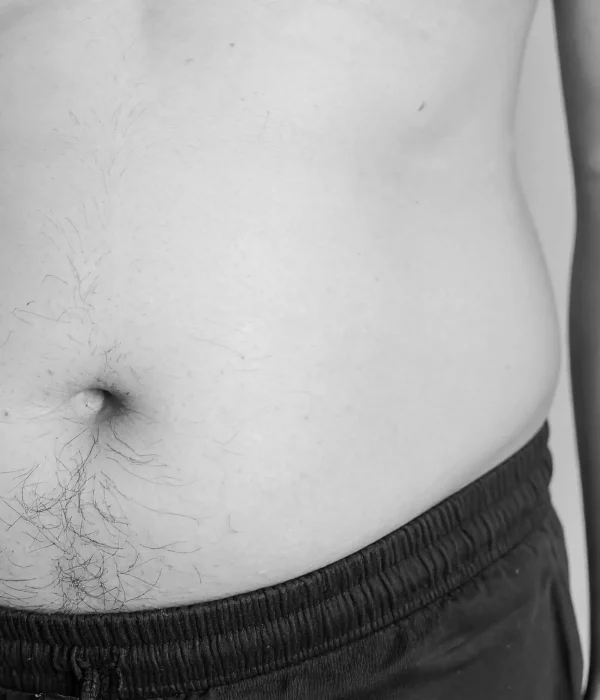 Liposuctie behandeling buik mannen buikvet man