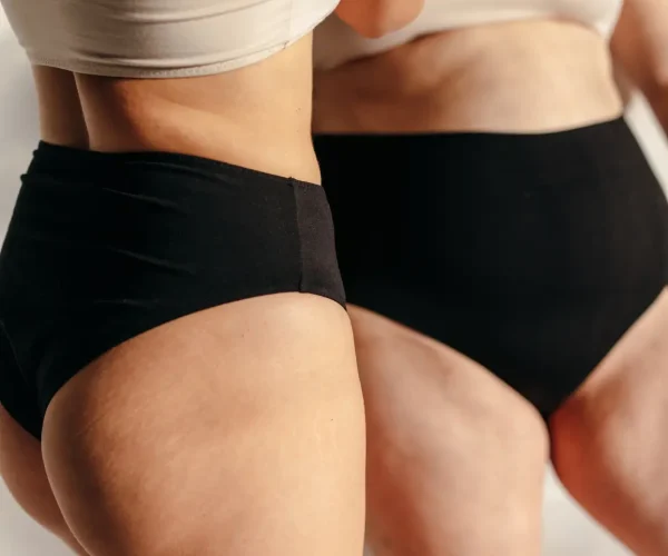 Liposuctie benen