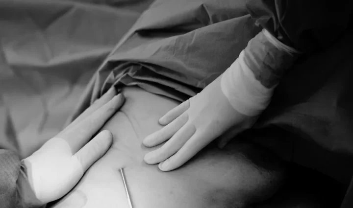 1e behandeling lipoedeem en liposuctie