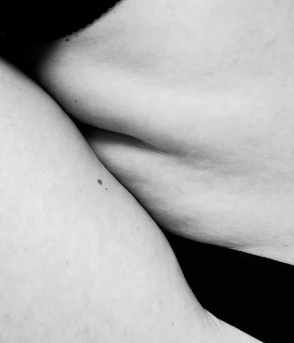 Tumescente liposuctie onder plaatselijke verdoving