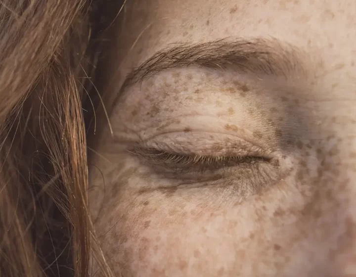 Geïrriteerde huid herkennen