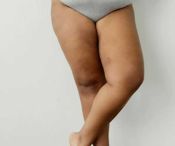 Afvallen benen: oplossingen & liposuctie