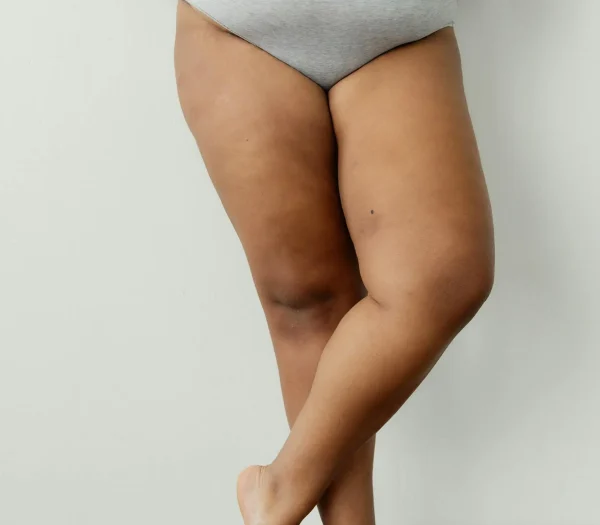 Afvallen benen: oplossingen & liposuctie