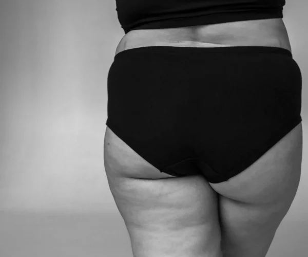 Dikke benen: oorzaken & behandeling