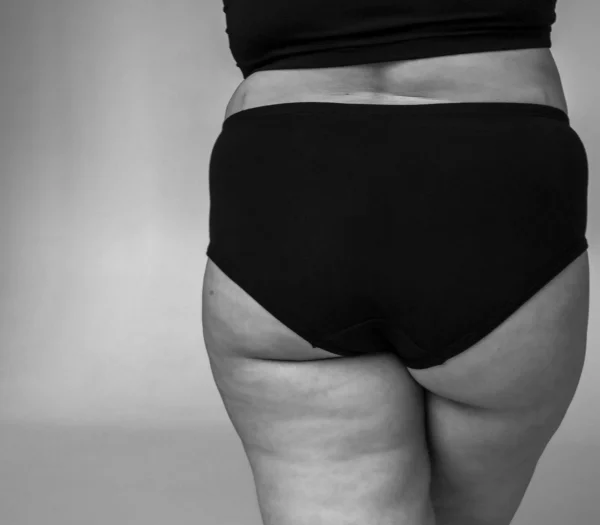Dikke benen: oorzaken & behandeling